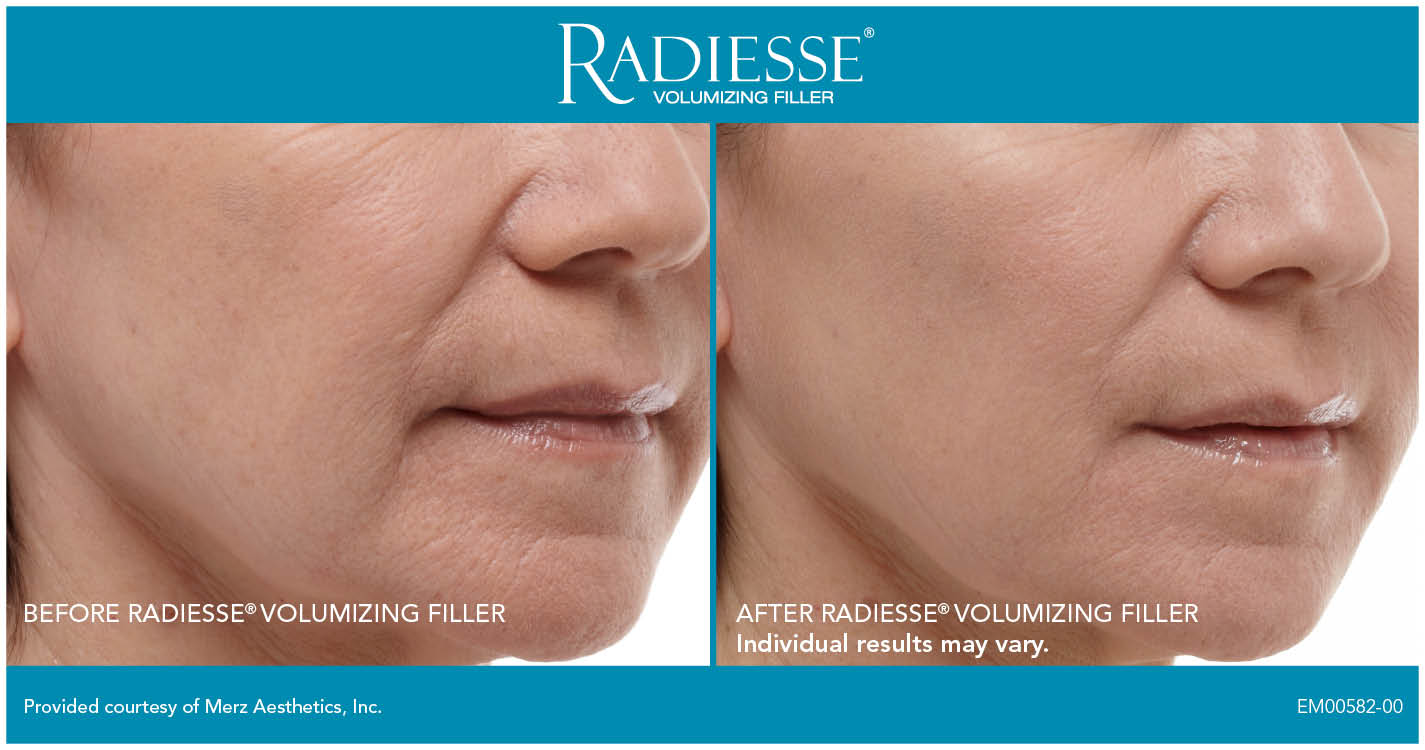 Why Dermal Fillers Are So Effective Radiance Skincare And Laser Medspa Wheaton Il 8257