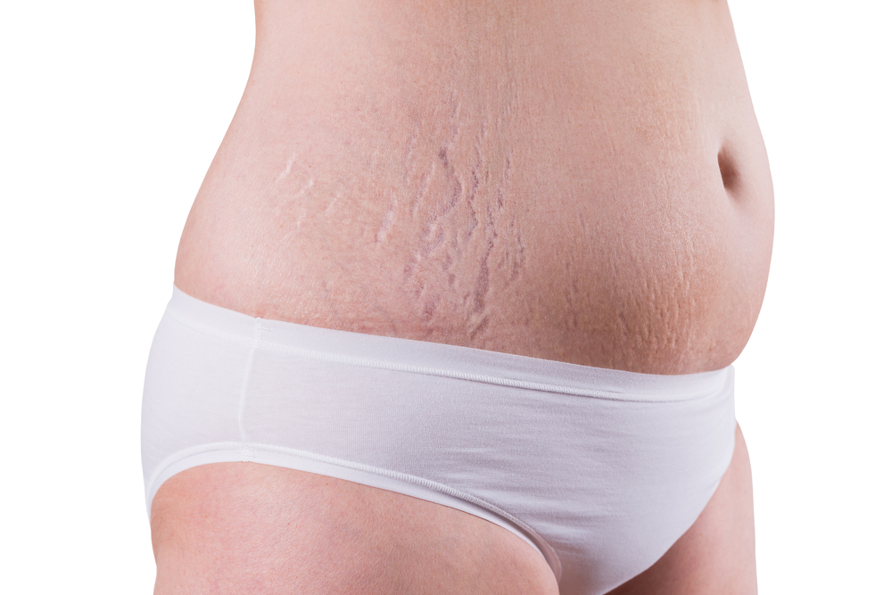 Can You Tighten Loose Skin After Losing Weight?