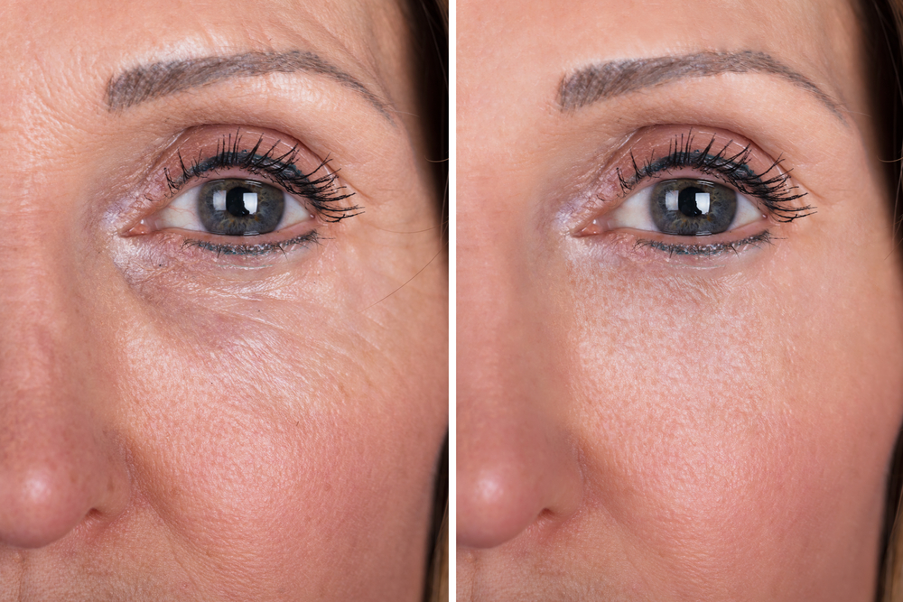 What Is Microneedling For Under Eye Bags Definition And Benefits
