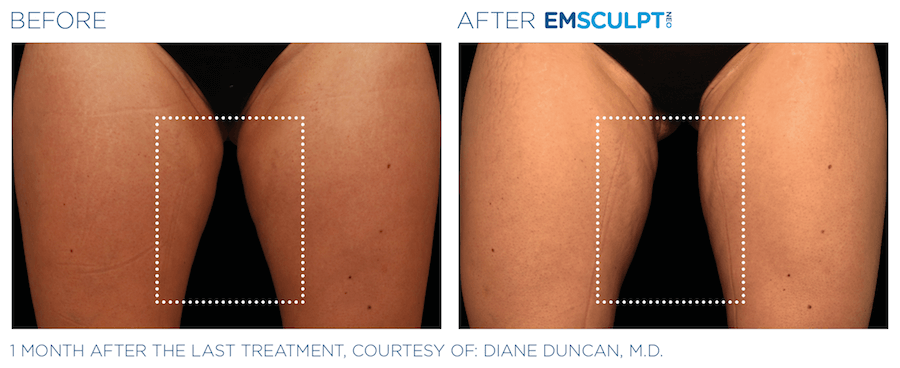 What's the Difference Between EMSCULPT NEO® and CoolSculpting