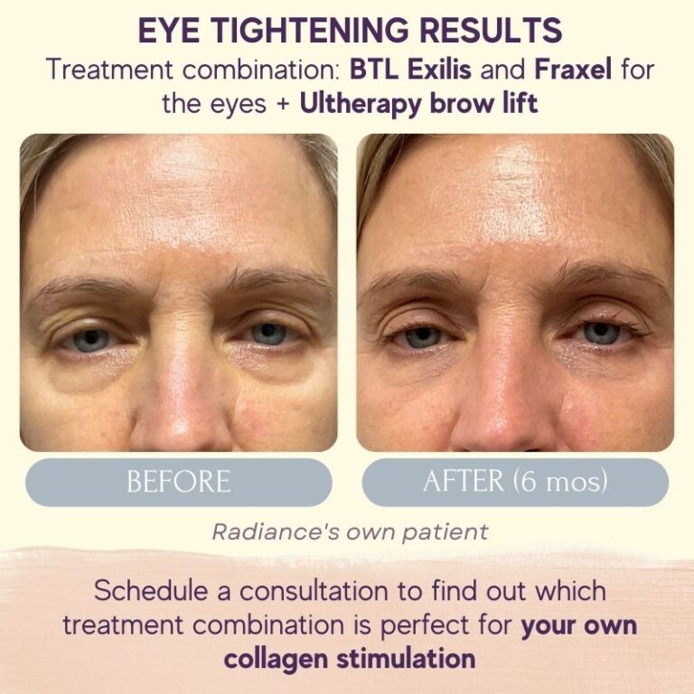 Skin Tightening Radiance Skincare And Laser Medspa Wheaton Il 7209